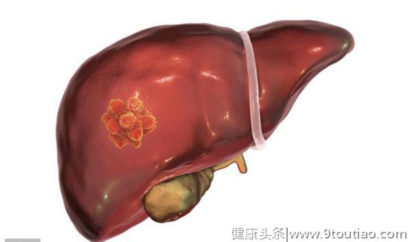 为何中国是“肝癌”大国？专家警示：这种食物千万不要在吃了
