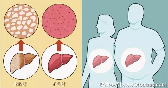 脂肪肝，中国第一大肝脏疾病！