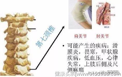 颈椎病会给你带来哪些危害？现在知道还不晚！赶紧看看吧！