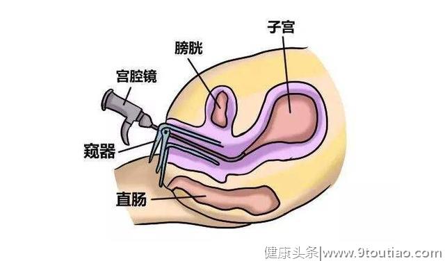 宫腔镜子宫肌瘤剔除术