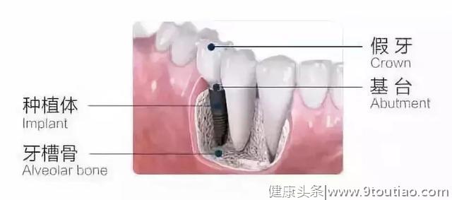 号外！缺牙，牙齿不好看？凭重庆身份证享补贴：10000元减免？