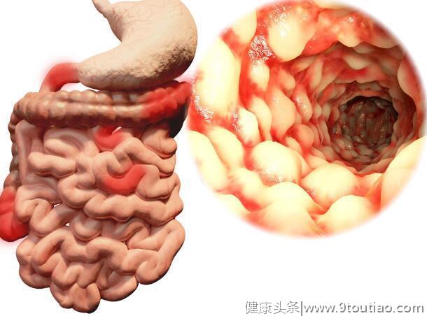 身体一旦出现这5种异常，十有八九是肠癌来了，需及时检查