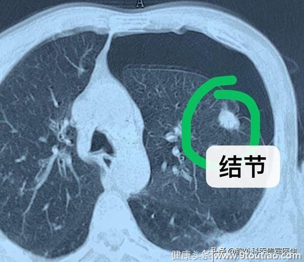 肺癌一般是由什么原因引起的？长期咳嗽会是肺癌吗？