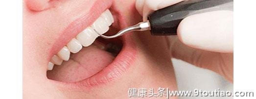 杭州美奥口腔牙齿美白多少钱？