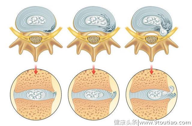 腰疼、屁股疼啥原因？医生提醒：可能是这3种病找上门，快看看