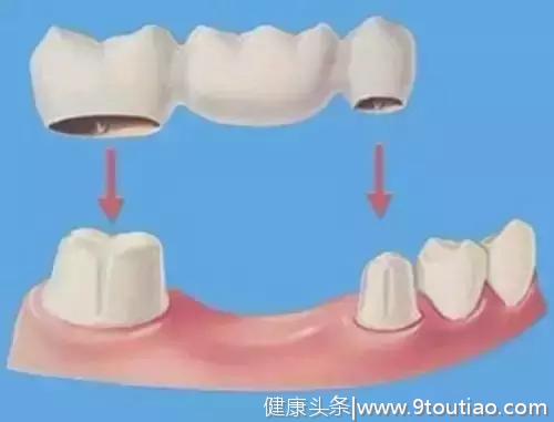 牙齿“三缺一” 人生就可能只剩一副散牌!