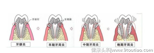 50岁的贾先生牙齿剧烈疼痛，原因公布竟然是吸烟导致