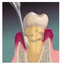 牙黄、牙垢，牙齿的疾病，科学证明，刷100次牙不如洗一次牙