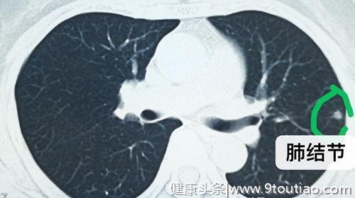 肺部CT检查发现有肺结节或肺占位就是肺癌吗？