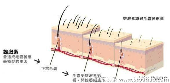 头发清洁不宜过密 4种原因 和脱发掉发有一定联系！