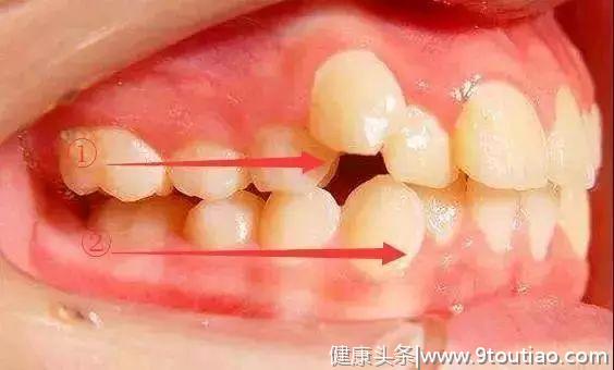 导致牙齿不齐的陷阱有很多，你掉进了哪一个？