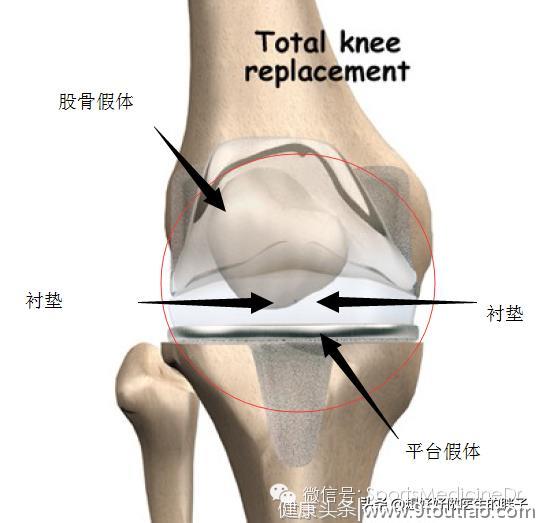 老年人膝关节疼痛的罪魁祸首-骨关节炎！谢医生带您了解膝关节二