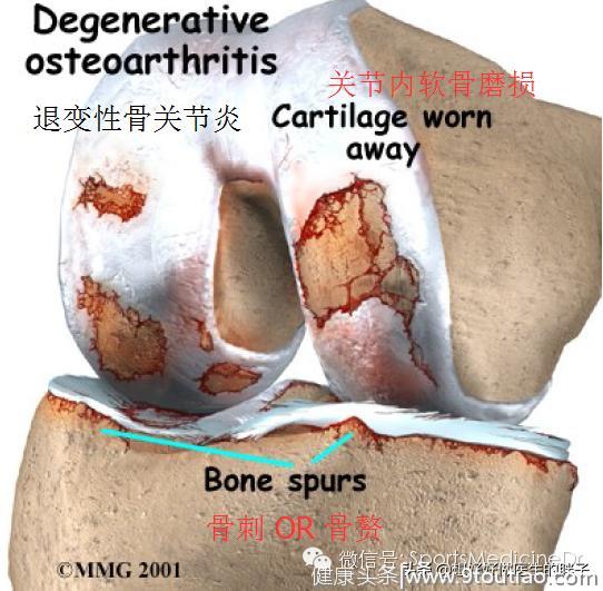 老年人膝关节疼痛的罪魁祸首-骨关节炎！谢医生带您了解膝关节二