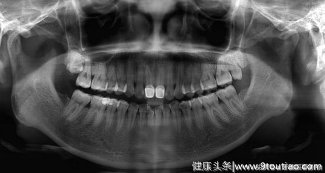 上牙医门诊总觉得要被坑，知道这些就不怕了