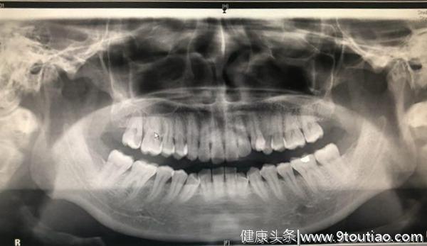 头痛得睡不着，原来是牙齿引起？！