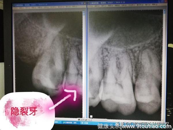 头痛得睡不着，原来是牙齿引起？！