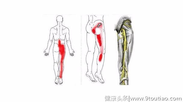 你的屁股疼痛 原来是坐骨神经的问题  针灸推拿效果非常好