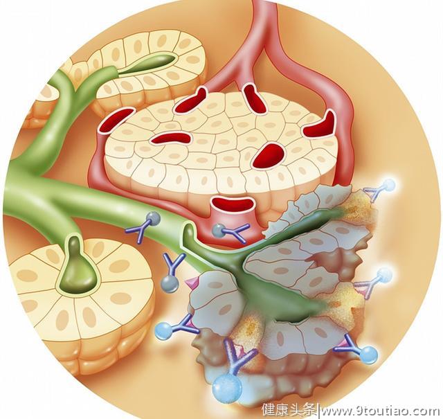 常让人束手无策的胰腺癌，偏偏喜欢找这类人群