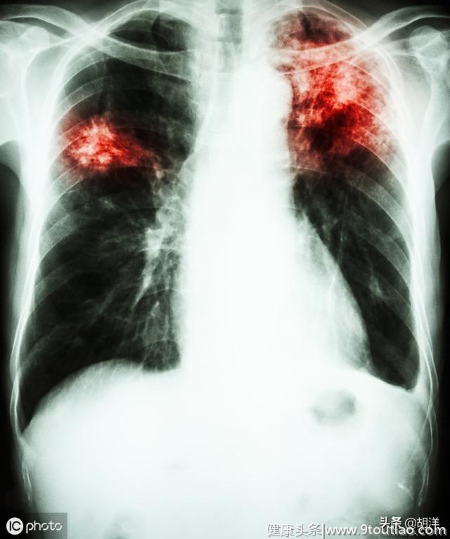 和肺结核很像的疾病有好几种，肺癌也有可能像结核，误诊后果严重