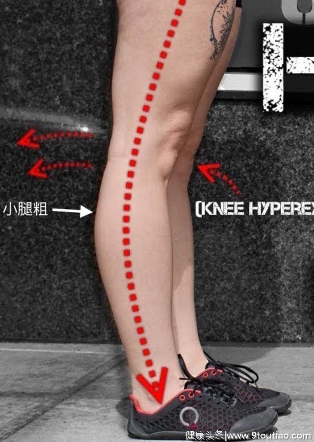 小腿粗壮？肌肉发达？你可能忽略了“膝超伸”！