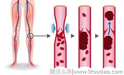 腿疼会要命，警惕静脉血栓栓塞症！记住这1个字，远离隐蔽杀手