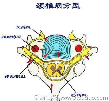 颈椎病的刮痧治疗