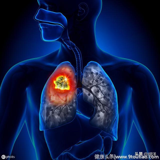 肺癌发病率那么高，肺部查出结节是不是应该马上开刀，要具体分析