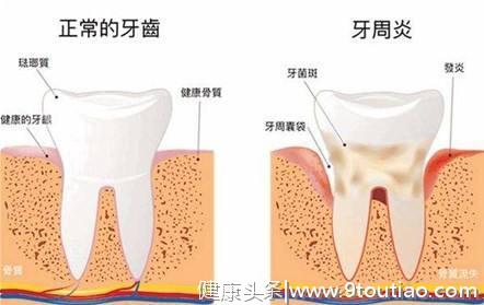 引发牙龈疾病的菌群可能与导致老年痴呆症的有关