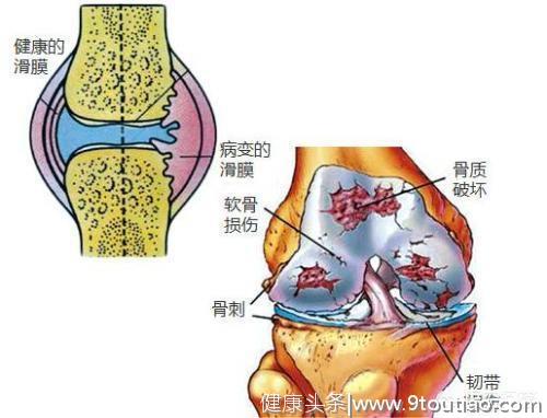 膝关节炎的手术治疗（一）：软骨移植、膝关节镜。