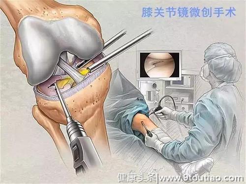 膝关节炎的手术治疗（一）：软骨移植、膝关节镜。