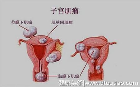 妇科子宫肌瘤