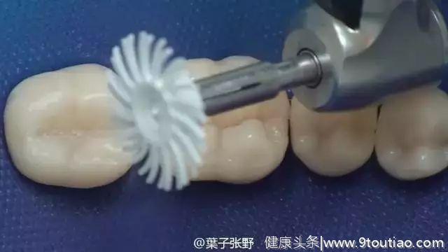 有蛀牙的人必看：一颗蛀牙被牙医拯救的过程（多图，易懂）