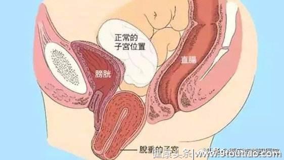 产后如何预防子宫脱垂？