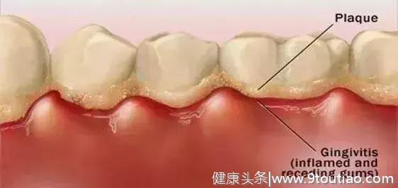 又一例被一颗小小牙齿夺走的生命，年龄：差3个月出生……