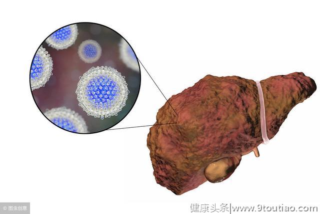 哪些症状代表您已患上肝硬化？如何通过饮食来调理？