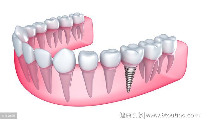 种一口牙相当于买了一辆宝马？种植牙虽好，也要“讲条件”