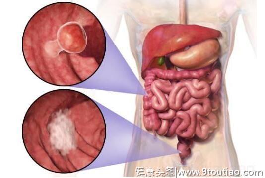 癌症免疫疗法研究新进展一览