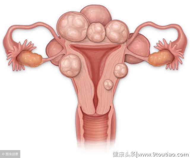 医生忠告：子宫肌瘤找上门，可能与3个坏习惯有关