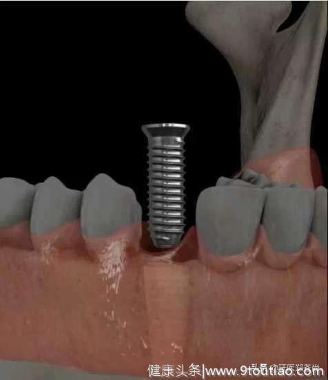 缺失牙的危害具体有多大？