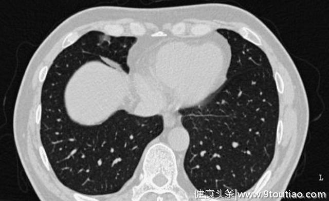 5年生存率达100％的早期微小肺癌却极易误诊为炎性结节？