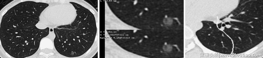 5年生存率达100％的早期微小肺癌却极易误诊为炎性结节？