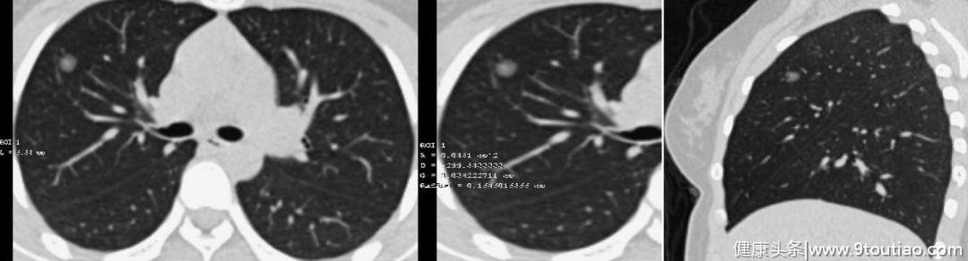 5年生存率达100％的早期微小肺癌却极易误诊为炎性结节？