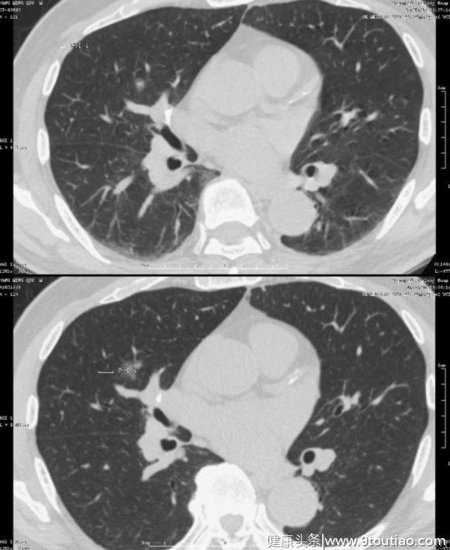 5年生存率达100％的早期微小肺癌却极易误诊为炎性结节？