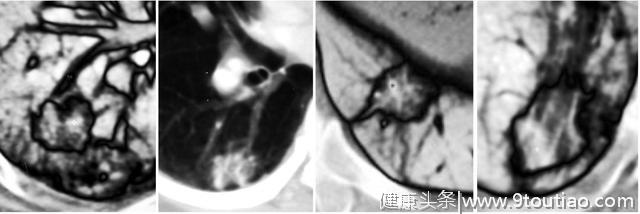 5年生存率达100％的早期微小肺癌却极易误诊为炎性结节？