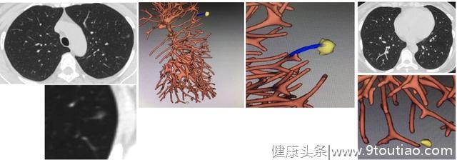 5年生存率达100％的早期微小肺癌却极易误诊为炎性结节？