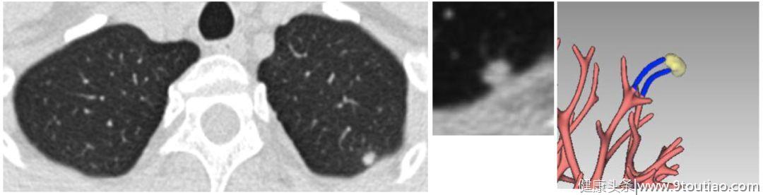 5年生存率达100％的早期微小肺癌却极易误诊为炎性结节？