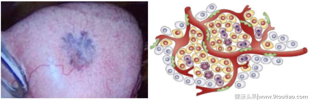 5年生存率达100％的早期微小肺癌却极易误诊为炎性结节？