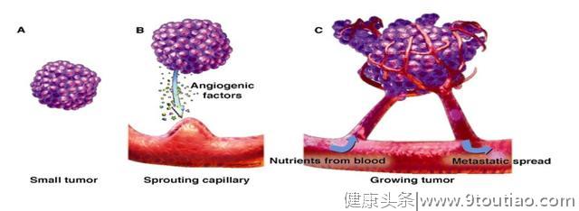 5年生存率达100％的早期微小肺癌却极易误诊为炎性结节？