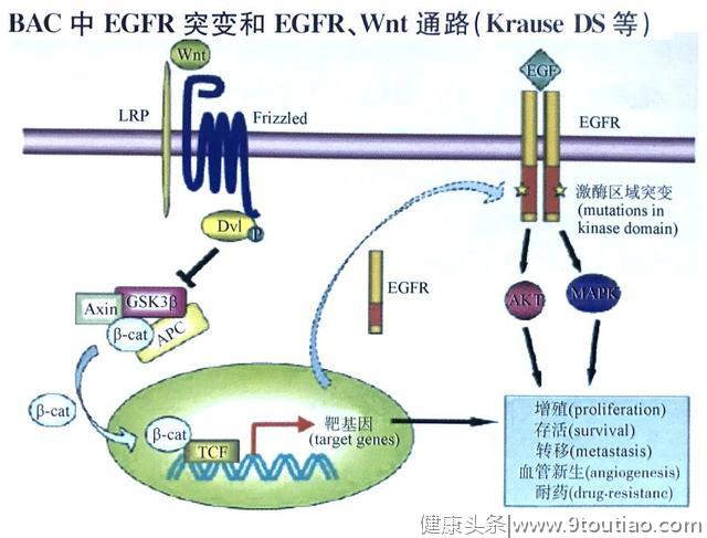 5年生存率达100％的早期微小肺癌却极易误诊为炎性结节？