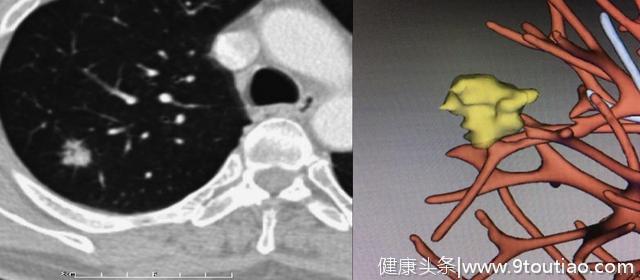 5年生存率达100％的早期微小肺癌却极易误诊为炎性结节？